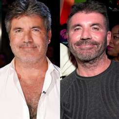 Simon Cowell Facial Surgery Analysis