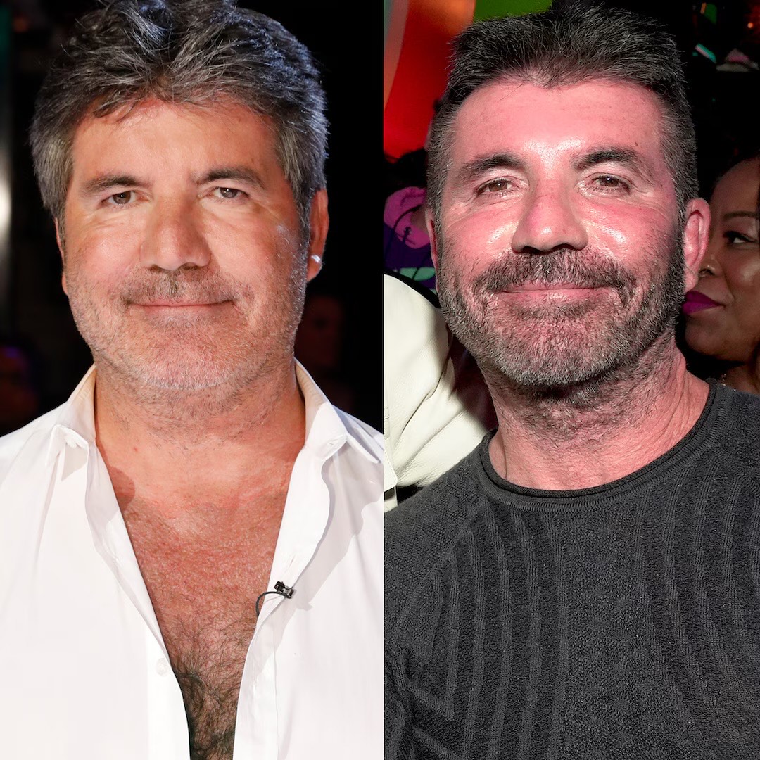 Simon Cowell Facial Surgery