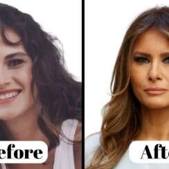 Melania Trump Cosmetic Surgery
