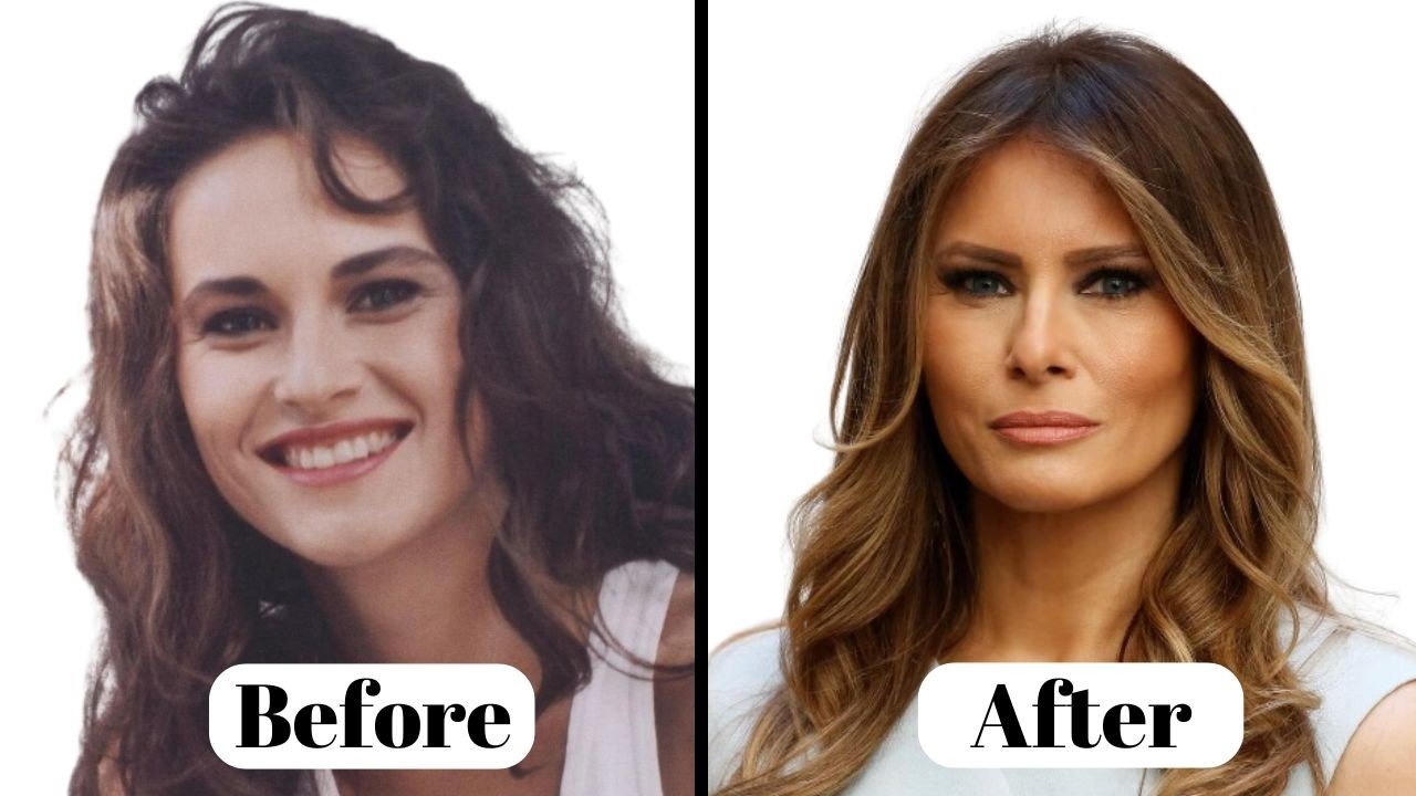 Melania Trump Cosmetic Surgery