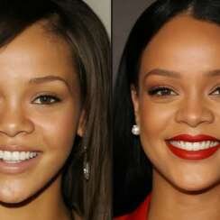 Did Rihanna Have Plastic Surgery?