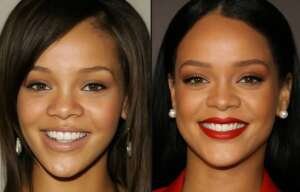 Did Rihanna Have Plastic Surgery?