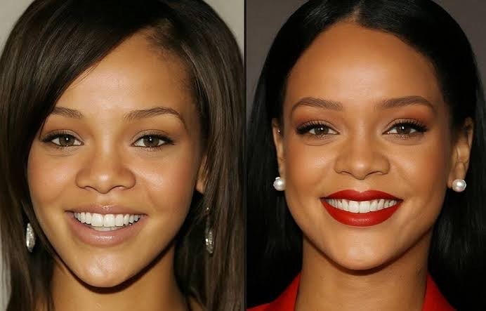 Did Rihanna Have Plastic Surgery?