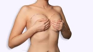 Plastic Surgery Breast Lift in Turkey