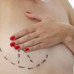 Breast Augmentation Surgery in Turkey: Procedure, Implant Types, Risks, and Benefits