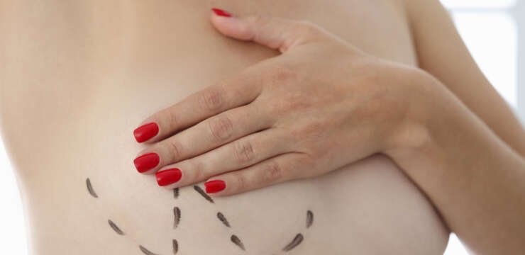 Breast Augmentation Surgery in Turkey