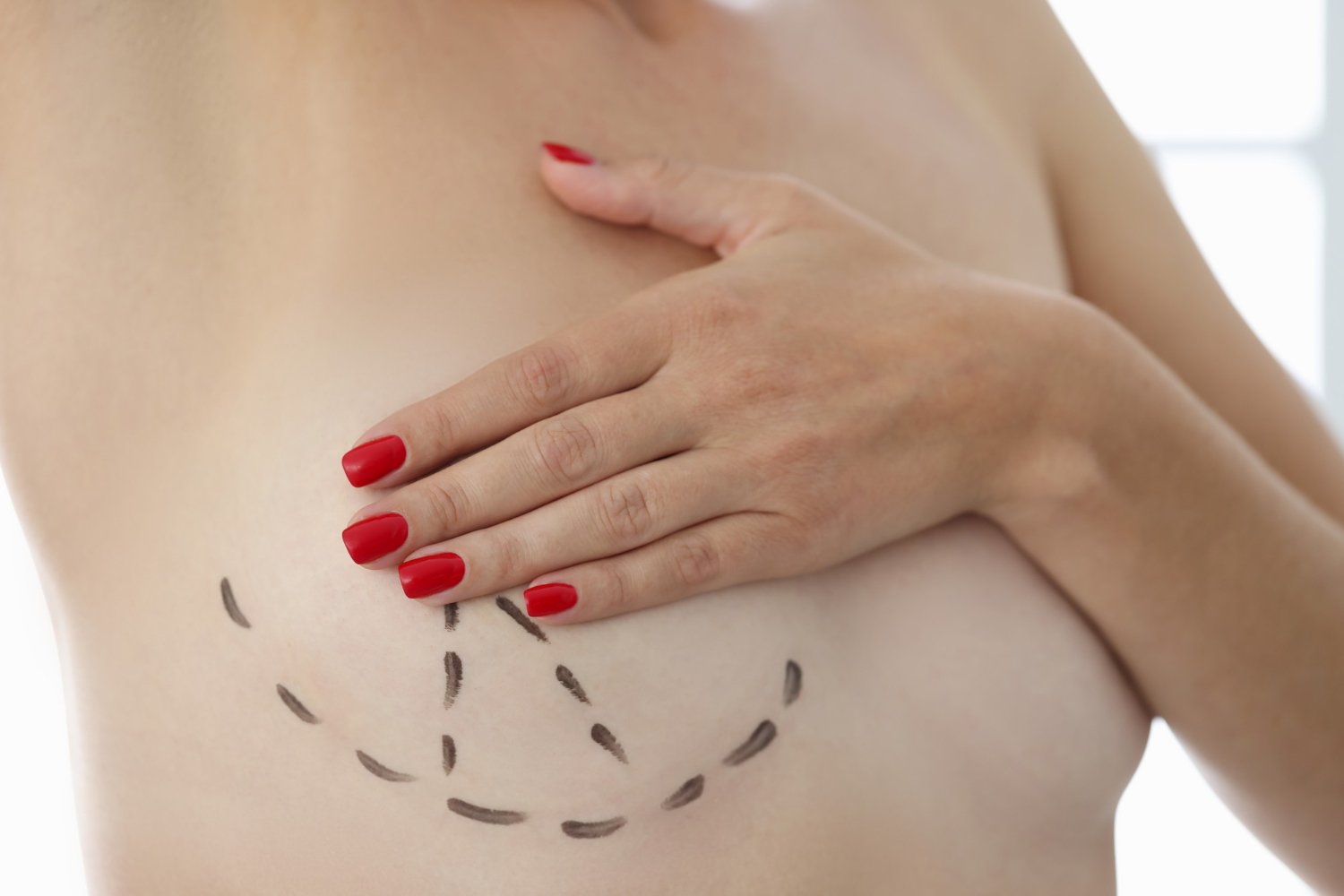Breast Augmentation Surgery in Turkey