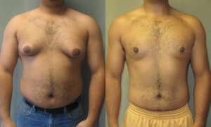 Breast Reduction Surgery